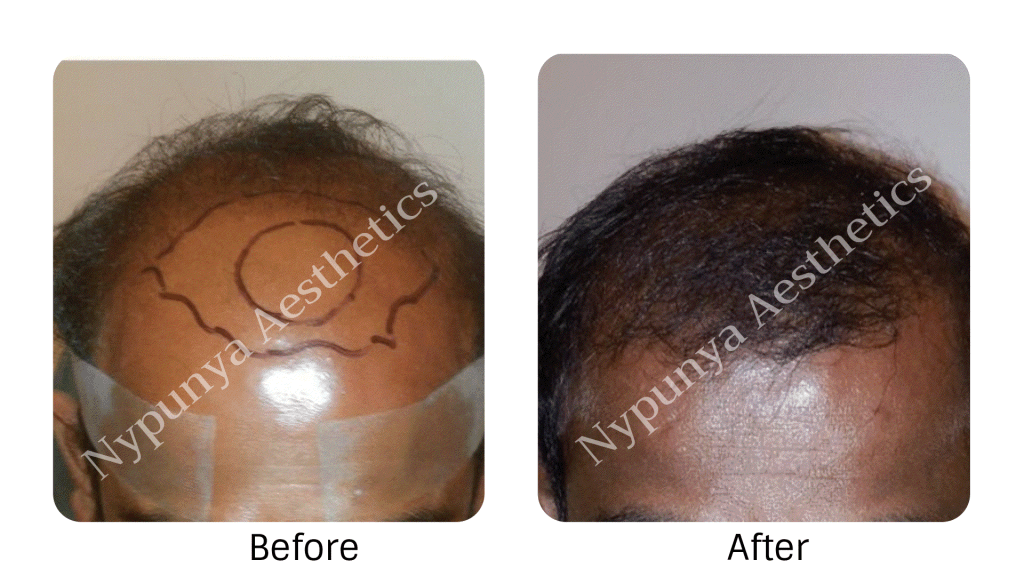 Hair Transplant | Nypunya Aesthetic Clinic