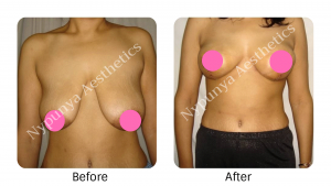 Breast reduction in Bangalore