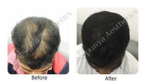 Hairfall treatment in bangalore