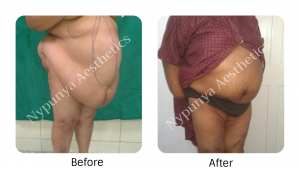 Liposuction / Body Contouring