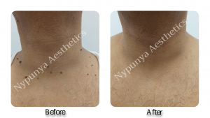 Freckle removal treatment