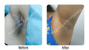 Laser hair removal by expert dermatologist