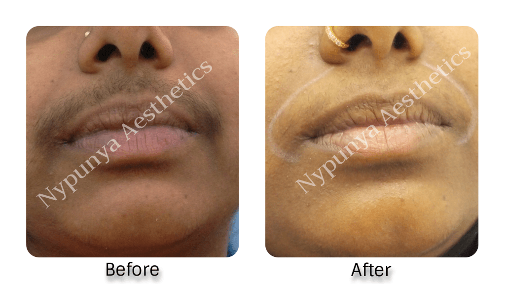 Laser Hair Removal | Nypunya Aesthetic Clinic