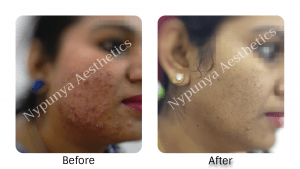 acne_treatment_in_bangalore