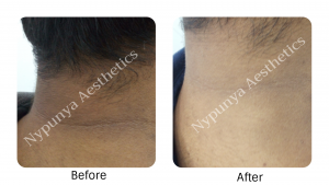Pigmentation treatment in Bangalore by expert dermatologist