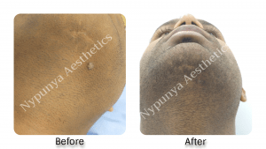 Mole removal treatment in bangalore