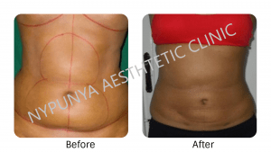 best_liposuction_treatment_nypunya