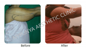 best_arm_liposuction_treatment_nypunya