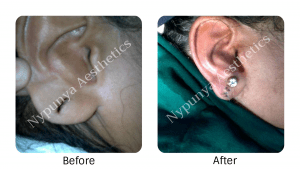 ear_lobe_correction_nypunya-clinic