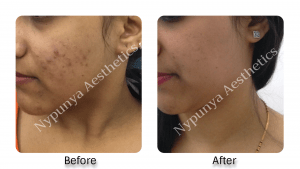 acne_treatment_in_bangalore
