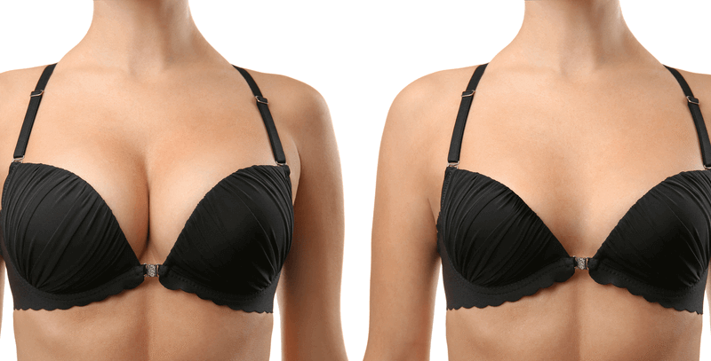 Breast_Augmentation Breast_Augmentation