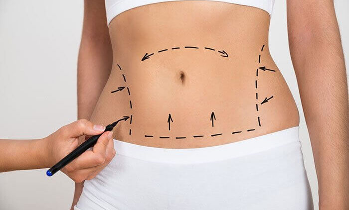 Liposuction-Surgery Liposuction-Surgery