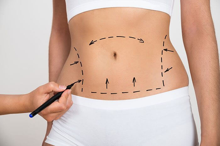 Liposuction-Surgery
