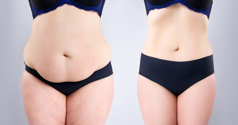 abdominoplasty-or-tummy-tuck-surgery-causes-procedure-recovery abdominoplasty-or-tummy-tuck-surgery-causes-procedure-recovery