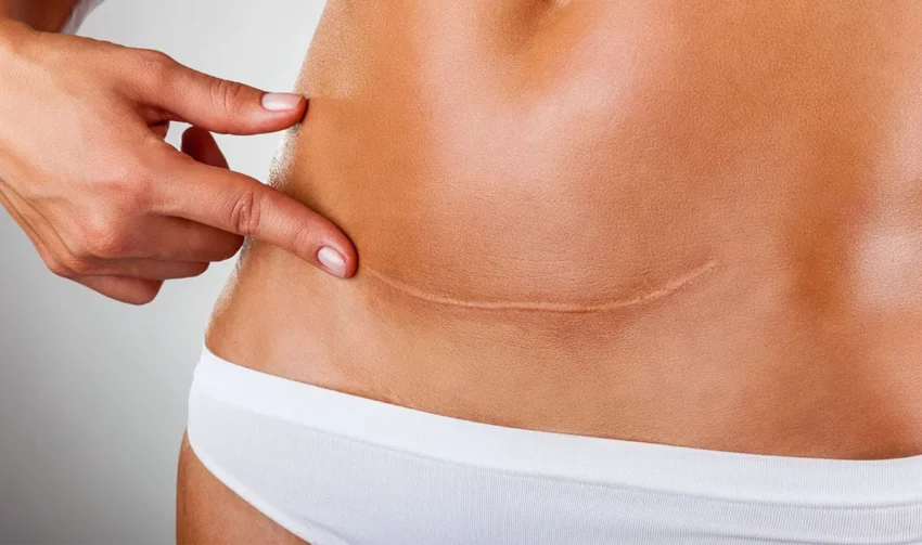 tummy-tuck-scar