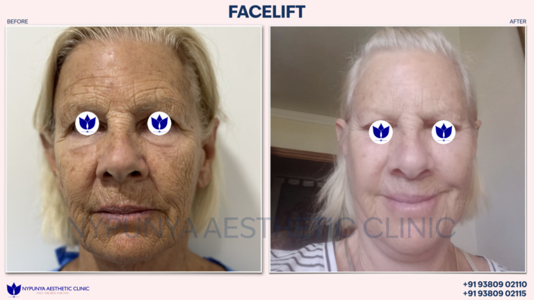 Before_After_Facelift_Neck_Lift_India_09