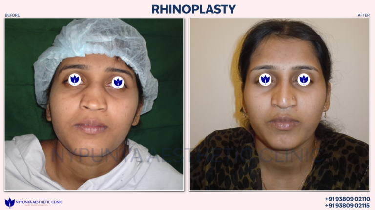 Fascialage_Expert_Rhinoplasty_Technique_India_24