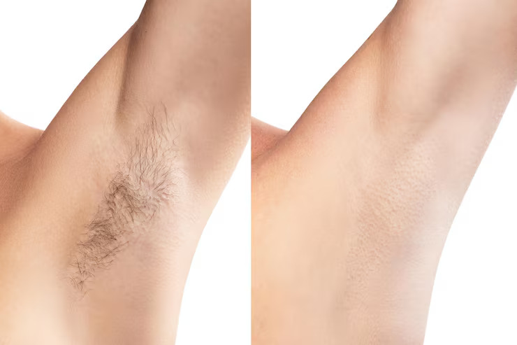 Laser Hair removal (1)