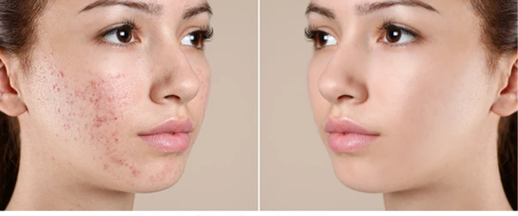 acne_gallery