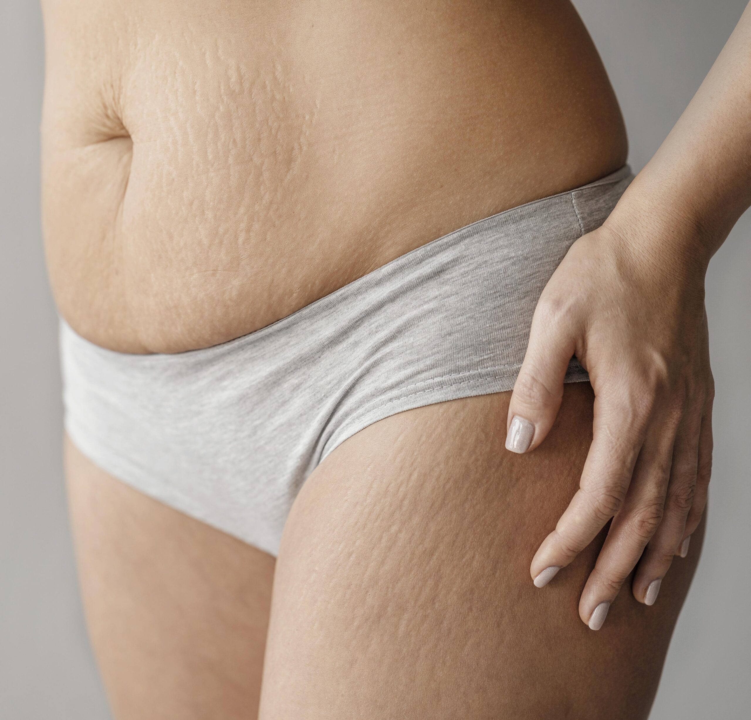 stretch mark remova;