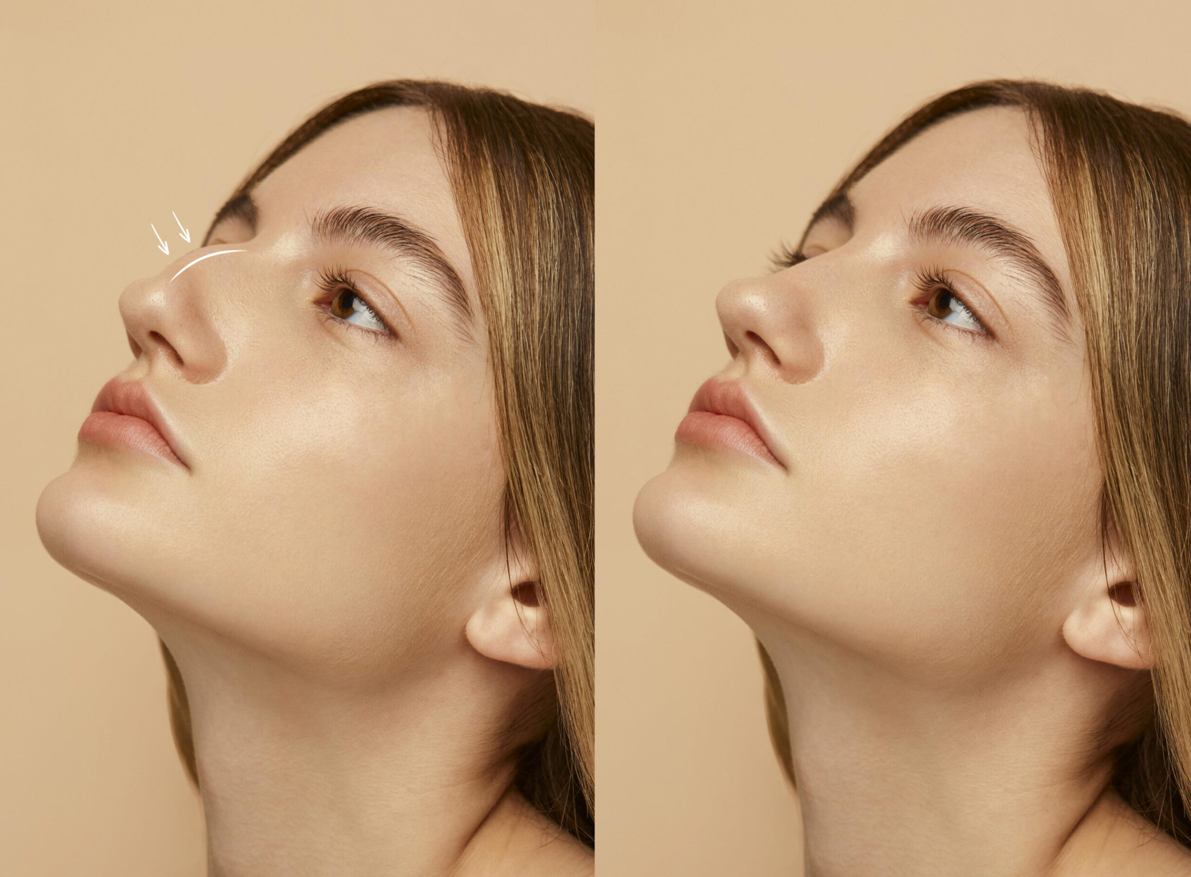 woman-getting-ready-nose-job-surgery