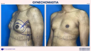 Before_After_Male_Breast_Lipo_10-300x169