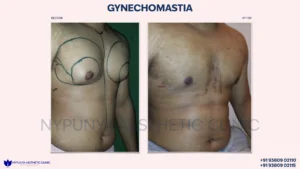 Before_After_Male_Breast_Lipo_11-300x169