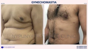 Chest_Liposuction_Gynecomastia_Results_05-300x169