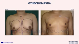 Chest_Reshaping_Liposuction_Gynecomastia_23-300x169
