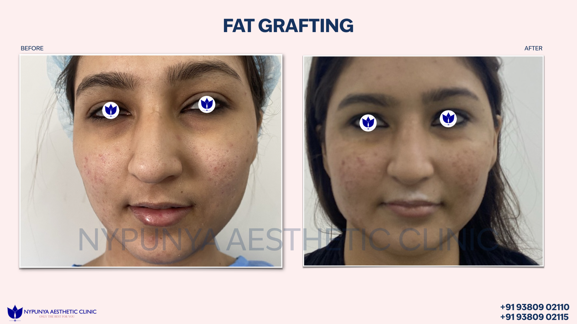 Fat_Grafting_Beautiful_Body_Contouring_India_23