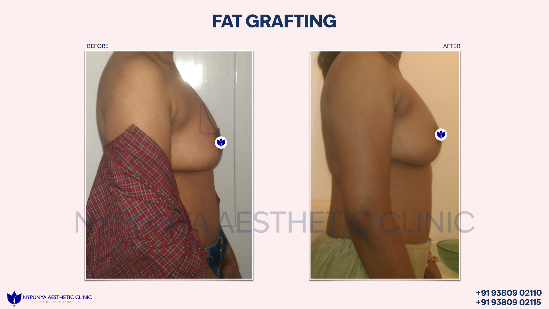 Fat_Grafting_Body_Enhancement_India_17