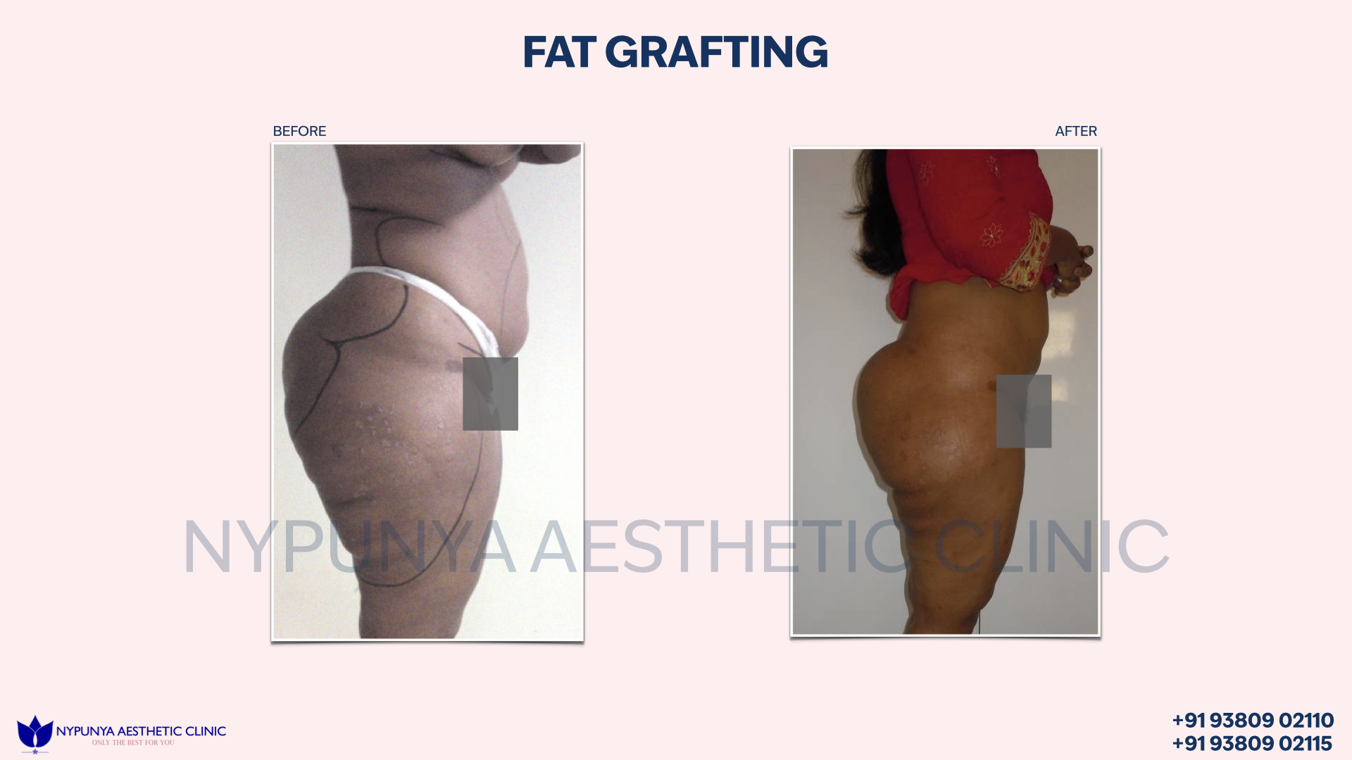 Fat_Grafting_Complete_Transformation_India_50