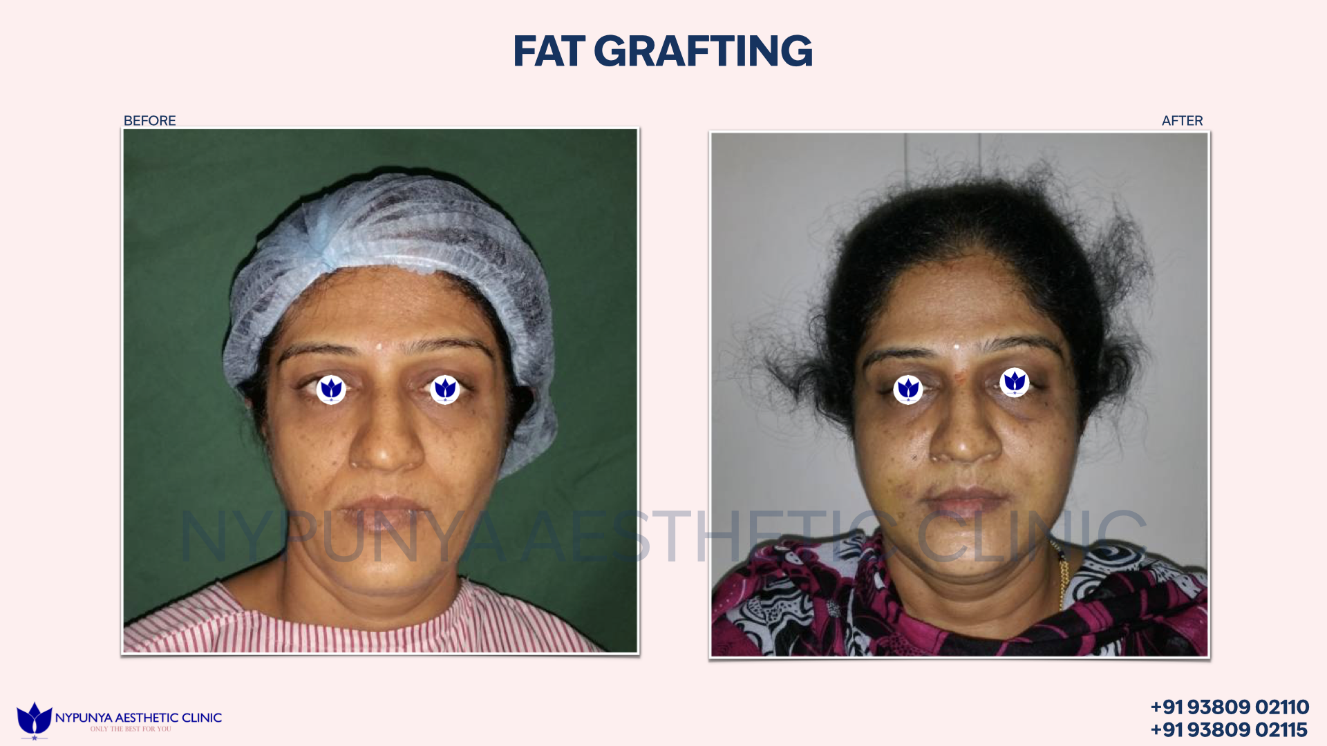 Fat_Grafting_Facial_Contour_India_07