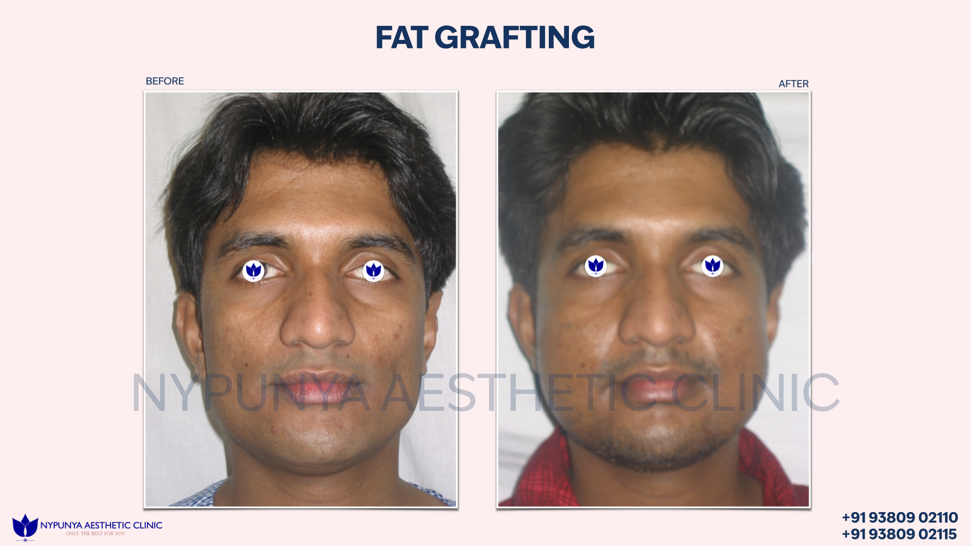 Fat_Grafting_Facial_Refinement_India_37