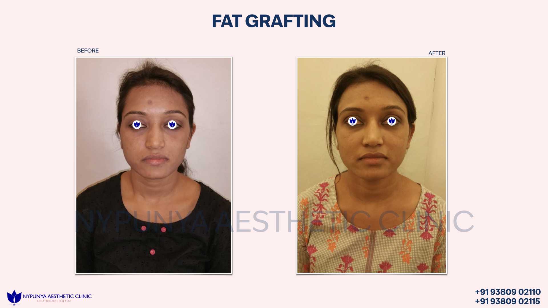 Fat_Grafting_Facial_and_Body_Enhancement_India_50