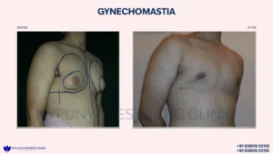 Flat_Chest_After_Gynecomastia_Liposuction_15-300x169