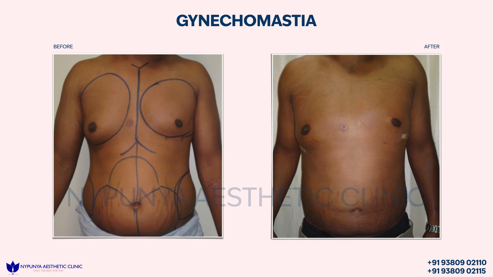 Gynecomastia_Lipo_Treatment_Before_After_17