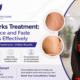 Stretch Marks Treatment How to Reduce and Fade Stretch Marks Effectively